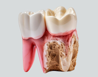 Introduction to Periodontal Disease