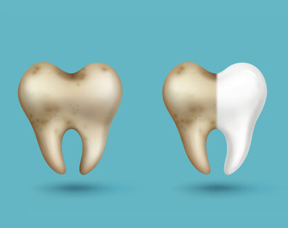 Tooth decay model.