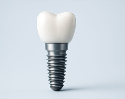 Why Dental Implants Are the Go-to Choice for Tooth Replacement